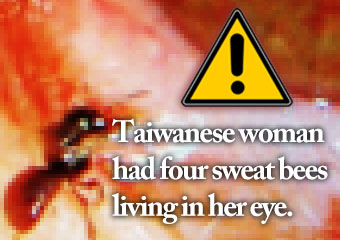 一名台灣女性的眼.. Taiwanese woman had four..